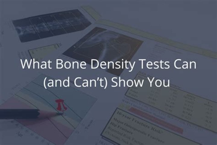 At what age should you stop getting bone density tests? |
