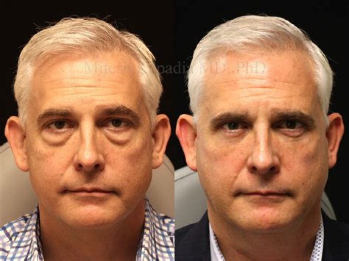 Before And After Surgery Revelations