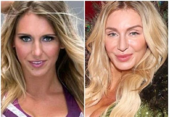 Charlotte Flair Before And After Surgery Pics, Age Wiki And Family