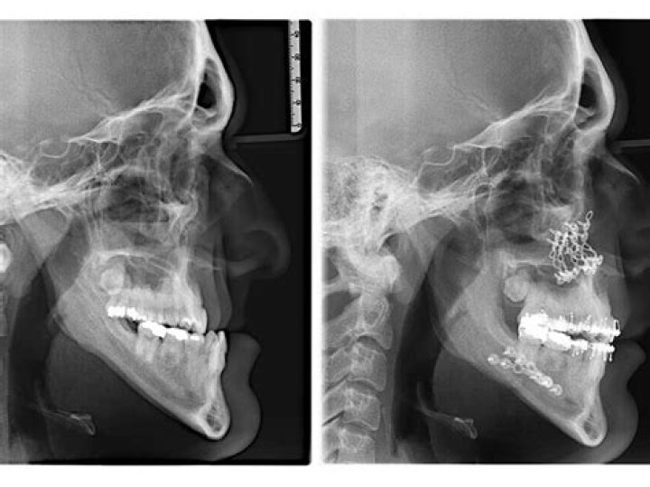 Fans Suspect Jaw Surgery ·