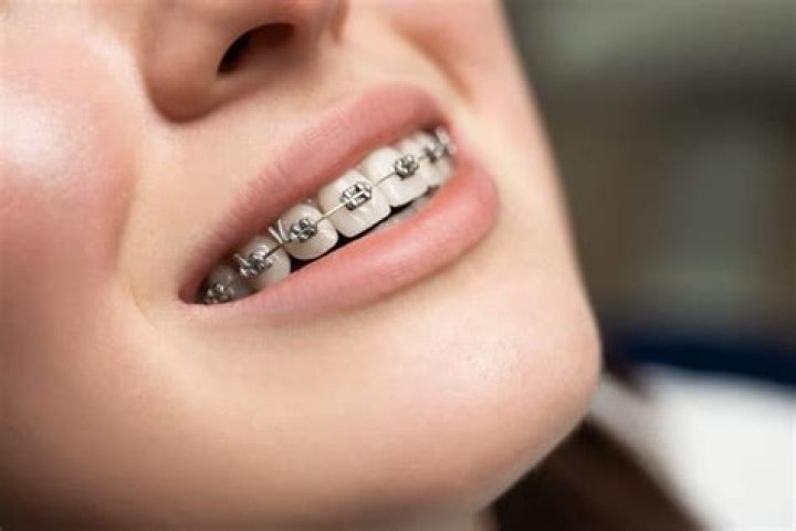 Has He Used Braces ·
