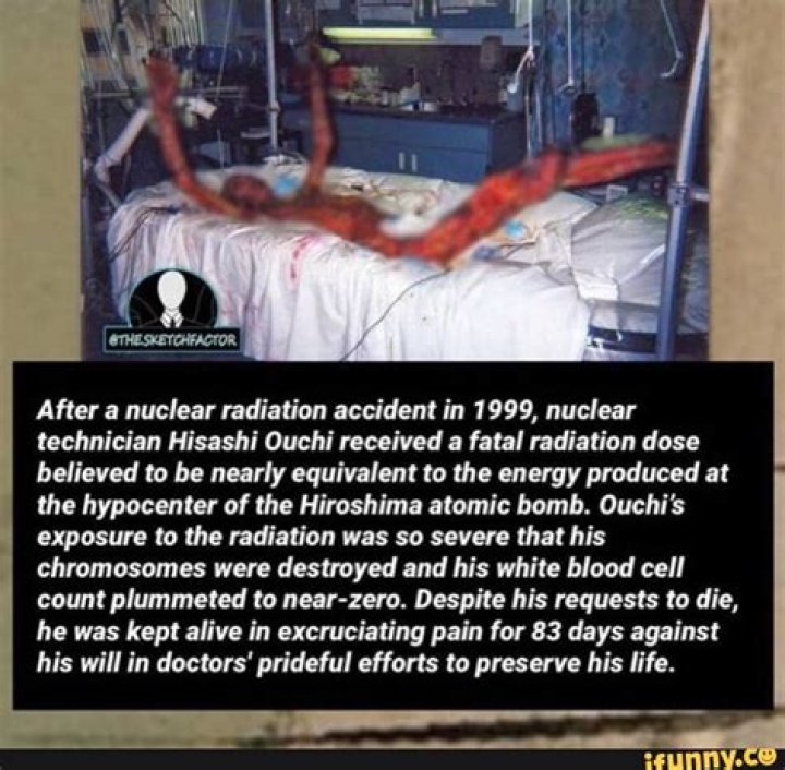 Hisashi Ouchi Corpse Photos, Man Suffered Nuclear And Radiation Accident ·