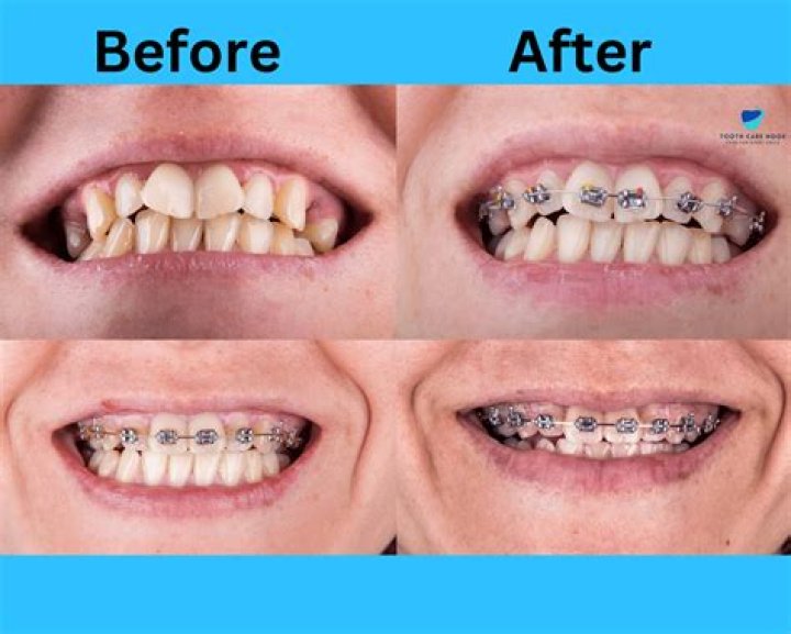 Uncovering The Allure Of "Braces That Look Like Grills"