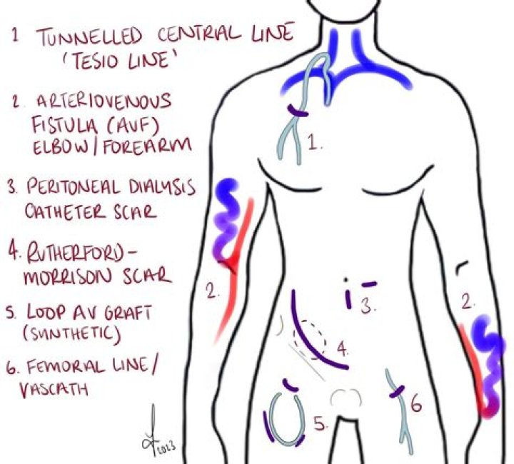 Unlocking The Secrets Of Scar Kidney Transplant: Discoveries That Transform Lives