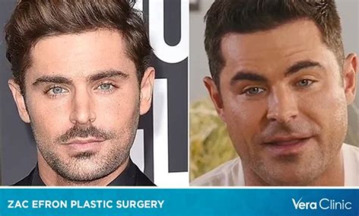 Unveiling Zac Efron's Face Surgery: Insights And Revelations