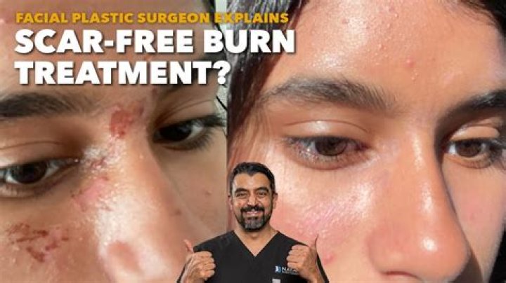 What Happened To Savitars Face In The Flash? Burn Scar Mark Reason