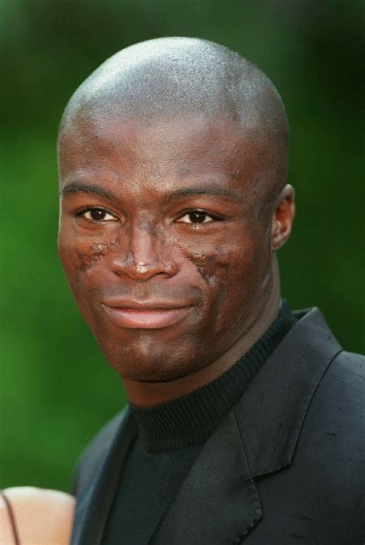 What Happened To Seal’s Face? Details On His Illness And Facial Scars
